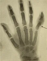 Picture 433 of 481 from Fractures and dislocations, diagnosis and treatment (1915), leaf 759