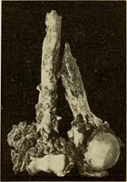Picture 434 of 481 from Fractures and dislocations, diagnosis and treatment (1915), leaf 759