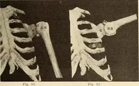 Picture 32 of 481 from Fractures and dislocations, diagnosis and treatment (1915), leaf 76
