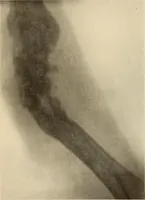 Picture 435 of 481 from Fractures and dislocations, diagnosis and treatment (1915), leaf 760