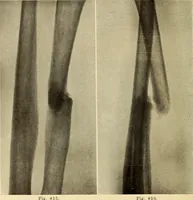 Picture 449 of 481 from Fractures and dislocations, diagnosis and treatment (1915), leaf 777