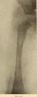 Picture 450 of 481 from Fractures and dislocations, diagnosis and treatment (1915), leaf 778