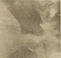 An illustration from Fractures and dislocations, diagnosis and treatment (1915)