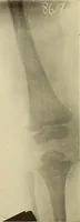 Picture 452 of 481 from Fractures and dislocations, diagnosis and treatment (1915), leaf 779