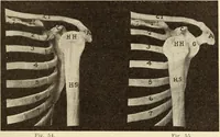 Picture 33 of 481 from Fractures and dislocations, diagnosis and treatment (1915), leaf 78