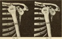 An illustration from Fractures and dislocations, diagnosis and treatment (1915)