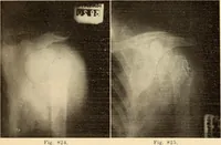 Picture 454 of 481 from Fractures and dislocations, diagnosis and treatment (1915), leaf 788