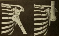 Picture 35 of 481 from Fractures and dislocations, diagnosis and treatment (1915), leaf 79