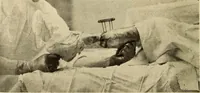 An illustration from Fractures and dislocations, diagnosis and treatment (1915)