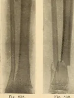 Picture 466 of 481 from Fractures and dislocations, diagnosis and treatment (1915), leaf 796