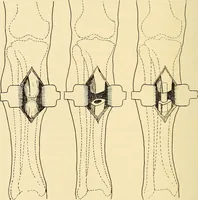 An illustration from Fractures and dislocations, diagnosis and treatment (1915)