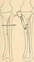 An illustration from Fractures and dislocations, diagnosis and treatment (1915)