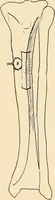 An illustration from Fractures and dislocations, diagnosis and treatment (1915)