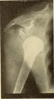 Picture 37 of 481 from Fractures and dislocations, diagnosis and treatment (1915), leaf 81