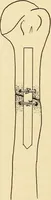 Picture 472 of 481 from Fractures and dislocations, diagnosis and treatment (1915), leaf 811