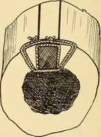 An illustration from Fractures and dislocations, diagnosis and treatment (1915)