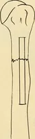An illustration from Fractures and dislocations, diagnosis and treatment (1915)