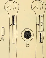 An illustration from Fractures and dislocations, diagnosis and treatment (1915)