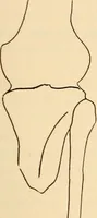 An illustration from Fractures and dislocations, diagnosis and treatment (1915)