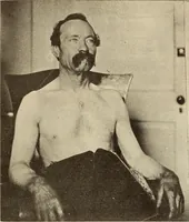 An illustration from Fractures and dislocations, diagnosis and treatment (1915)