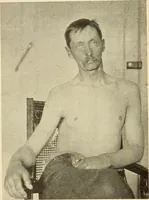 Picture 42 of 481 from Fractures and dislocations, diagnosis and treatment (1915), leaf 87