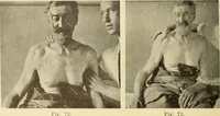 Picture 43 of 481 from Fractures and dislocations, diagnosis and treatment (1915), leaf 87