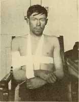 Picture 45 of 481 from Fractures and dislocations, diagnosis and treatment (1915), leaf 89