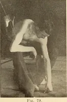 An illustration from Fractures and dislocations, diagnosis and treatment (1915)