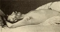 An illustration from Fractures and dislocations, diagnosis and treatment (1915)