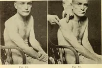 An illustration from Fractures and dislocations, diagnosis and treatment (1915)