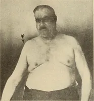 Picture 52 of 481 from Fractures and dislocations, diagnosis and treatment (1915), leaf 96