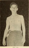 Picture 53 of 481 from Fractures and dislocations, diagnosis and treatment (1915), leaf 98