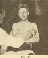 Picture 56 of 481 from Fractures and dislocations, diagnosis and treatment (1915), leaf 98