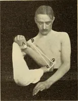 An illustration from Fractures and dislocations, diagnosis and treatment (1915)