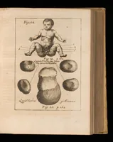 An illustration from Miscellanea curiosa, sive, Ephemeridum medico-physicarum Germanicarum (1677)