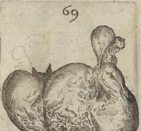 Picture 20 of 23 from Monstrorum historia memorabilis : monstrosa humanorum partuum miracula : stupendis conformationum formulis ab vtero materno enata : viuis exemplis, obseruationibus, & picturis, referens : accessit analogicum argumentum de monstris brutis : Supplementi loco ad observationes medicas Schenkianas edita (1609), leaf 106