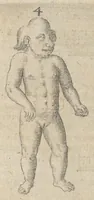 Picture 4 of 23 from Monstrorum historia memorabilis : monstrosa humanorum partuum miracula : stupendis conformationum formulis ab vtero materno enata : viuis exemplis, obseruationibus, & picturis, referens : accessit analogicum argumentum de monstris brutis : Supplementi loco ad observationes medicas Schenkianas edita (1609), leaf 16