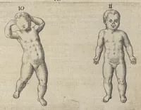 An illustration from Monstrorum historia memorabilis : monstrosa humanorum partuum miracula : stupendis conformationum formulis ab vtero materno enata : viuis exemplis, obseruationibus, & picturis, referens : accessit analogicum argumentum de monstris brutis : Supplementi loco ad observationes medicas Schenkianas edita (1609)
