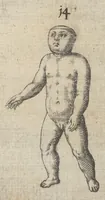 Picture 7 of 23 from Monstrorum historia memorabilis : monstrosa humanorum partuum miracula : stupendis conformationum formulis ab vtero materno enata : viuis exemplis, obseruationibus, & picturis, referens : accessit analogicum argumentum de monstris brutis : Supplementi loco ad observationes medicas Schenkianas edita (1609), leaf 26