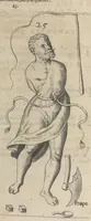 An illustration from Monstrorum historia memorabilis : monstrosa humanorum partuum miracula : stupendis conformationum formulis ab vtero materno enata : viuis exemplis, obseruationibus, & picturis, referens : accessit analogicum argumentum de monstris brutis : Supplementi loco ad observationes medicas Schenkianas edita (1609)