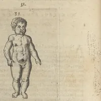 An illustration from Monstrorum historia memorabilis : monstrosa humanorum partuum miracula : stupendis conformationum formulis ab vtero materno enata : viuis exemplis, obseruationibus, & picturis, referens : accessit analogicum argumentum de monstris brutis : Supplementi loco ad observationes medicas Schenkianas edita (1609)