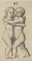 Picture 16 of 23 from Monstrorum historia memorabilis : monstrosa humanorum partuum miracula : stupendis conformationum formulis ab vtero materno enata : viuis exemplis, obseruationibus, & picturis, referens : accessit analogicum argumentum de monstris brutis : Supplementi loco ad observationes medicas Schenkianas edita (1609), leaf 80