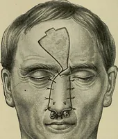 An illustration from Grundriss und Atlas der allgemeinen Chirurgie (1905)