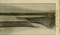 Picture 36 of 110 from Grundriss und Atlas der allgemeinen Chirurgie (1905), leaf 115