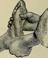 An illustration from Grundriss und Atlas der allgemeinen Chirurgie (1905)