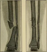 Picture 42 of 110 from Grundriss und Atlas der allgemeinen Chirurgie (1905), leaf 133