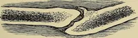 An illustration from Grundriss und Atlas der allgemeinen Chirurgie (1905)
