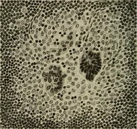 Picture 69 of 110 from Grundriss und Atlas der allgemeinen Chirurgie (1905), leaf 330