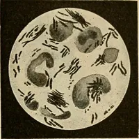 An illustration from Grundriss und Atlas der allgemeinen Chirurgie (1905)