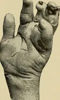 An illustration from Grundriss und Atlas der allgemeinen Chirurgie (1905)